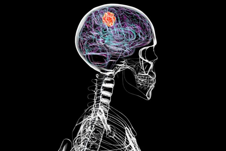 brain tumor x ray illustration